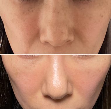 ビションフリーゼ　おもち 自分の事ですが  おもちふくと、シミ顔の経過 2836799B-08FC-4E3D-AE0B-0C5ED22702FA-380x373