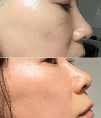 ビションフリーゼ　おもち 自分の事ですが  おもちふくと、シミ顔の経過 887DBE91-2E6B-4AE1-BE07-E73DADACF55E-325x380