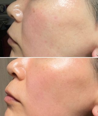 ビションフリーゼ　おもち 自分の事ですが  おもちふくと、シミ顔の経過 DFD16435-4FB3-4F2A-BE5D-122F9E6267E5-320x380